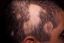 Kortizon Saç Dökülmesi Belirtileri ve Tedavisi