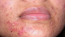 Kortizon Sivilce Belirtileri ve Tedavisi