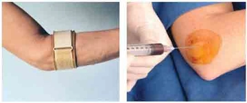 Tenisçi Dirseği Kortizon Tedavisi